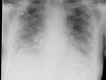 肺炎后遗症可能有解 一种抗癌药物可逆转肺部纤维化